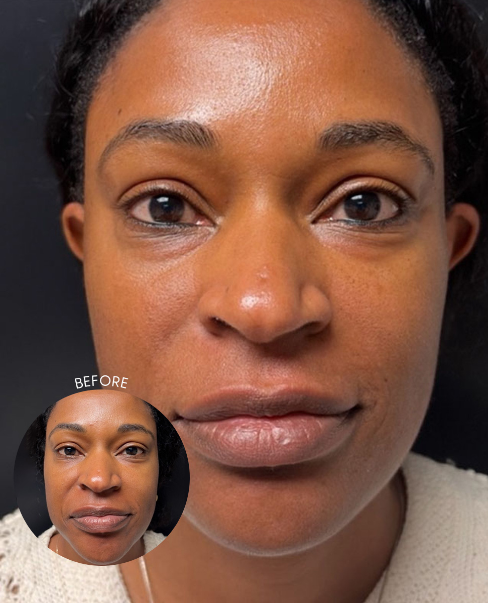 microneedling before and after Hero 8.6