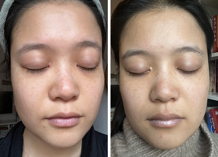 nuderma high frequency wand review: mw before and after