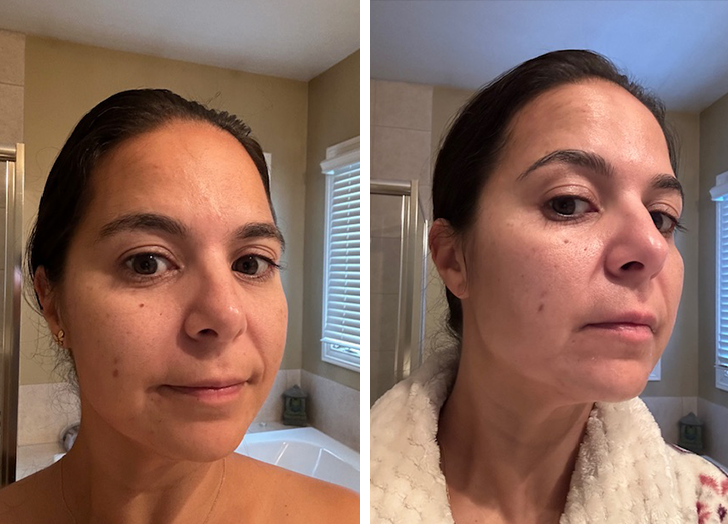 nuderma high frequency wand review: ss before and after