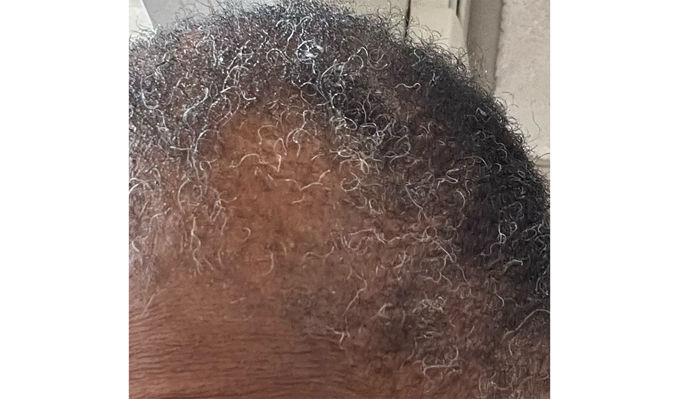 CurrentBody LED Hair Growth Helmet before and after image.