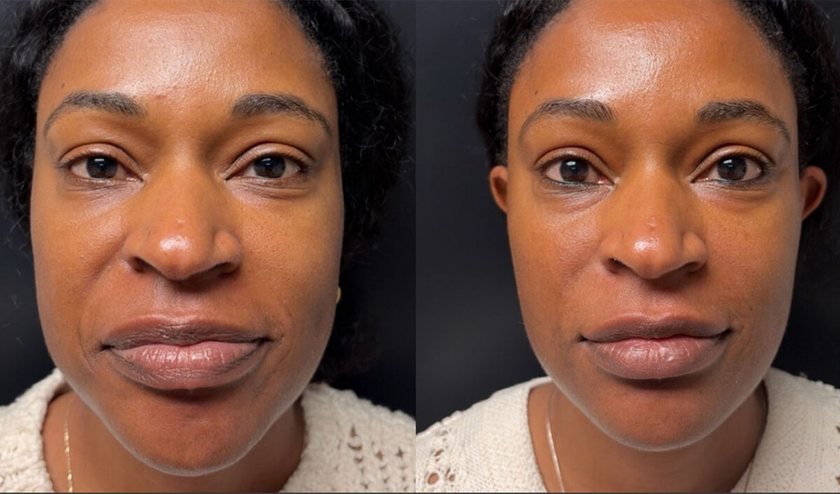 microneedling-before-and-after
