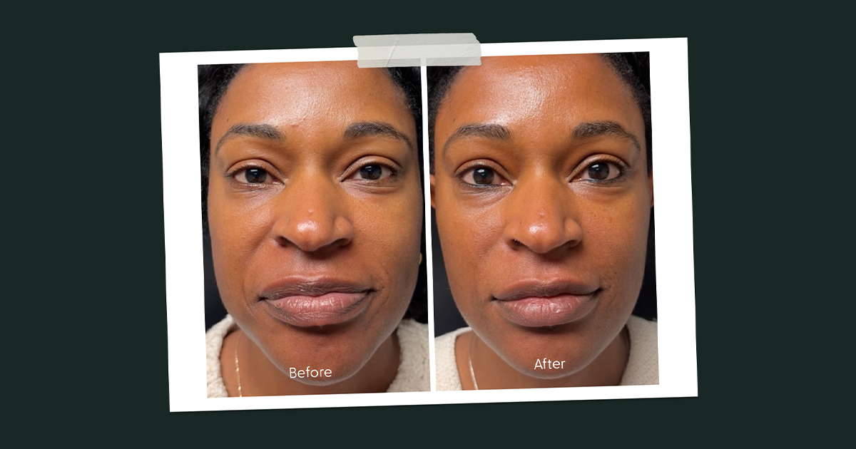 Before & After: Baby's First Microneedling Treatment