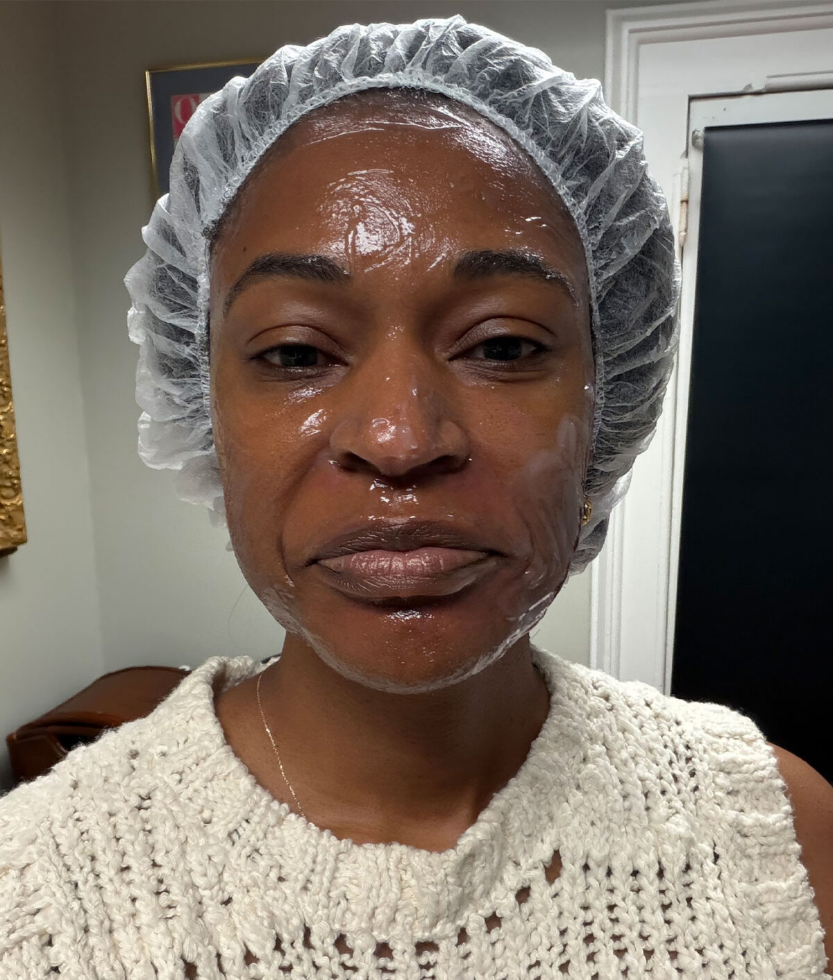 microneedling-before-and-after: hours afterward the treatment