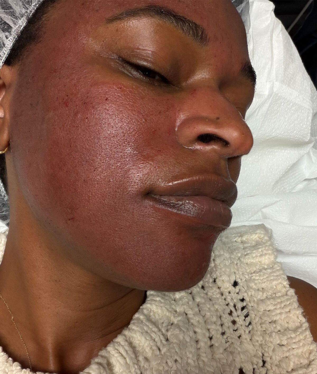 microneedling-before-and-after: redness and post-treatment regimen