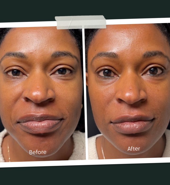 microneedling-before-and-after