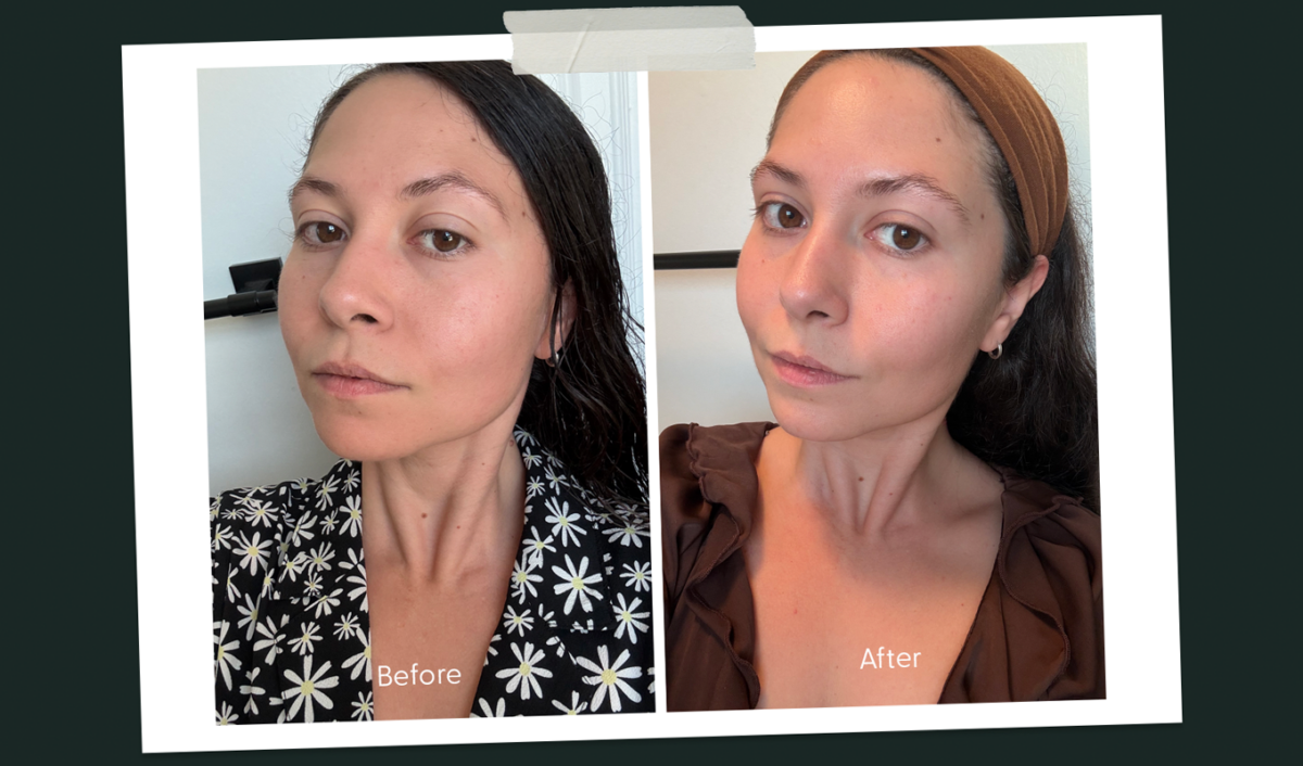 ME chemical peel before and after 1200x706
