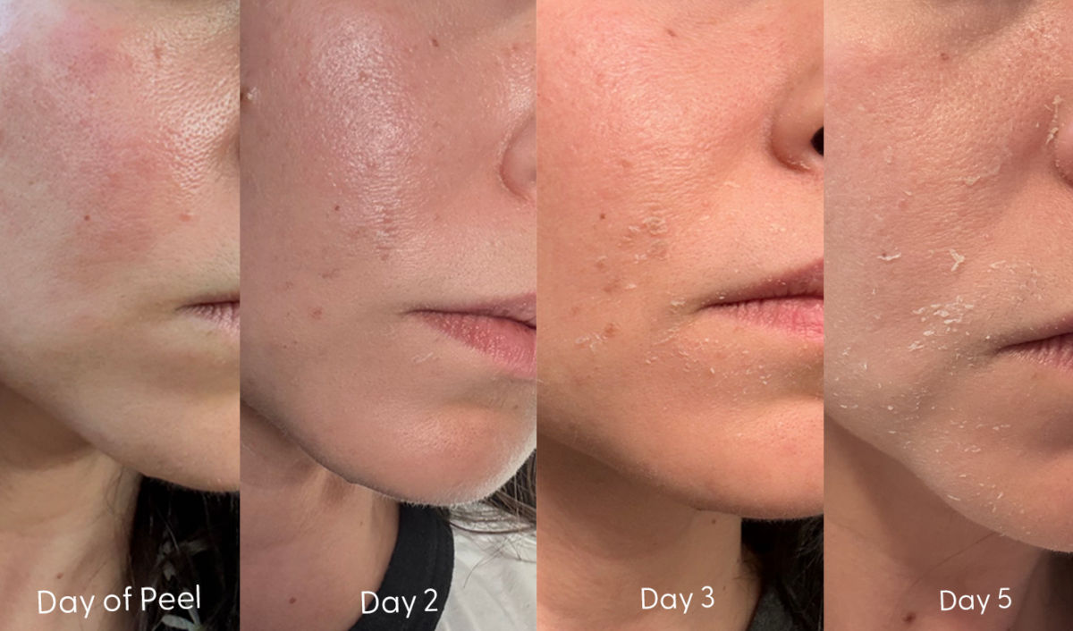 MEpeelprogression1 1200x706
