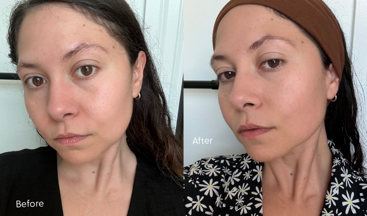 iRestore Illumina LED Mask Review: Original before and after photos of Stephanie Maida after two months